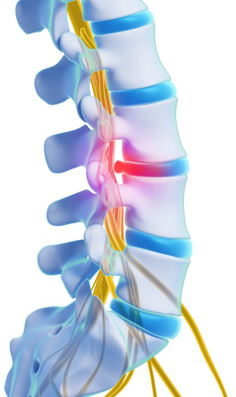 Bandscheibenprotrusion
