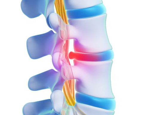 Bandscheibenprotrusion